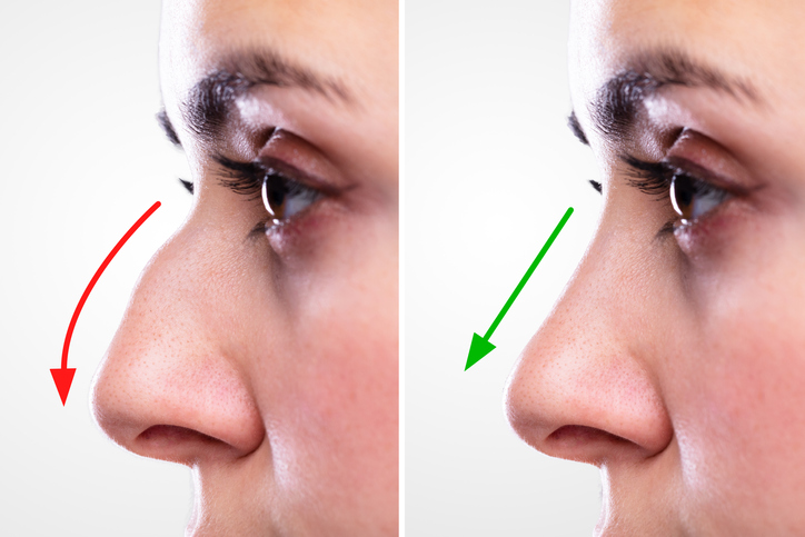 Woman's Nose Before and After Rhinoplasty