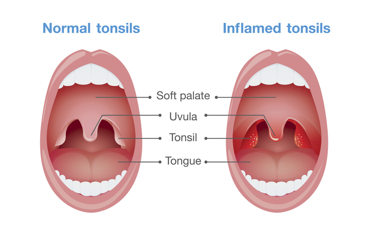 Normal tonsils and inflamed tonsils.
